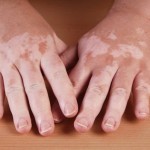 Pigmentschwund / Vitiligo (© Axel Bueckert / Fotolia)