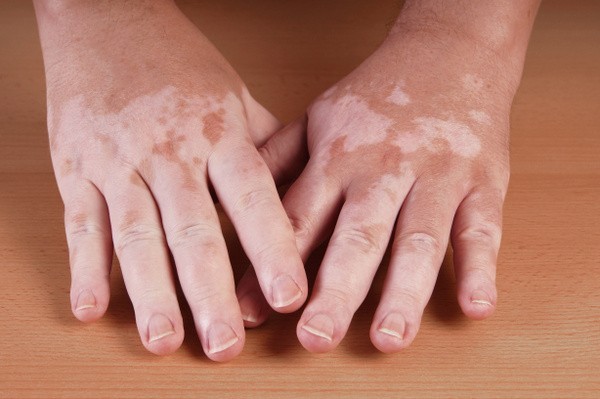 Pigmentschwund / Vitiligo (© Axel Bueckert / Fotolia)