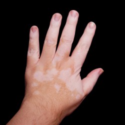 Pigmentstörung: weiße Flecken Pigmentstörung VITILIGO - weiße Flecken auf dem Handrücken (© Axel Bueckert / Fotolia)