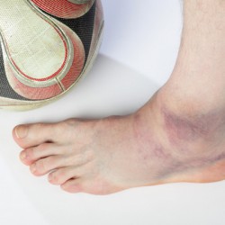 Prellungen – stumpfe Verletzungen an Haut, Muskel oder Gelenken Verletzung durch Sport: Eine Prellung / stumpfe Verletzung (hier Gelenkprellung) passiert sehr schnell (© Leo - Fotolia.com)