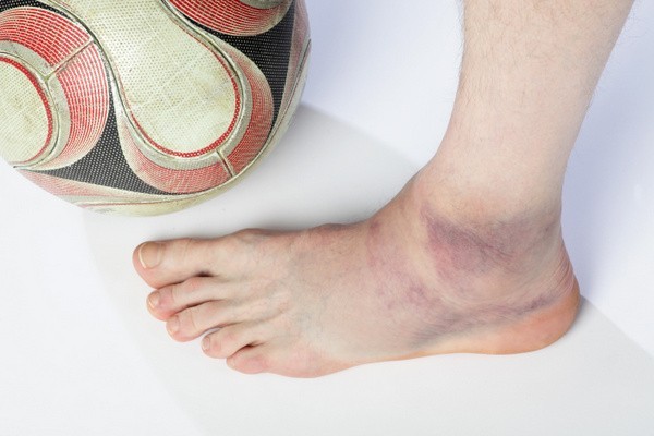 Verletzung durch Sport: Eine Prellung / stumpfe Verletzung (hier Gelenkprellung) passiert sehr schnell (© Leo - Fotolia.com)