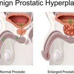 Prostataerkrankung / Prostata-Vergrößerung (© peterjunaidy - Fotolia.com)