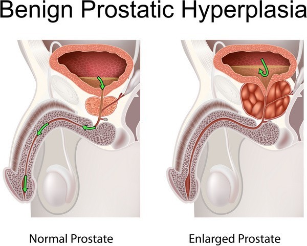 Prostataerkrankung / Prostata-Vergrößerung (© peterjunaidy - Fotolia.com)