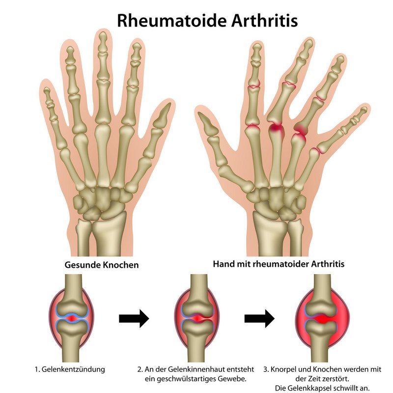 Rheumatoide / rheumatische Arthritis (© bilderzwerg / Fotolia)
