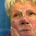 Frau mit Rosazea / Rosacea (© robert mobley - Fotolia.com)