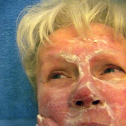 Hauterkrankungen im mittleren Alter – was ist Rosazea / Rosacea? Frau mit Rosazea / Rosacea (© robert mobley - Fotolia.com)