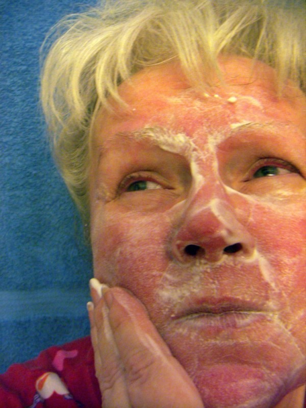 Frau mit Rosazea / Rosacea (© robert mobley - Fotolia.com)