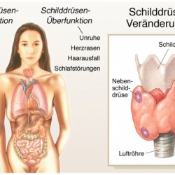 Schilddrüsenunterfunktion | Symptome, Ursachen, Arten und Behandlung Schilddrüsenunterfunktion: Krankmacher Schilddrüse (© Henrie - Fotolia.com)