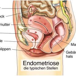 Schokoladenzysten (Endometriose) Endometriose / Schokoladenzysten (© Henrie - Fotolia.com)