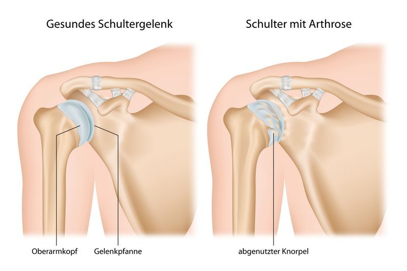 Gesundes Schultergelenk vs. Schulter mit Arthrose (© bilderzwerg / Fotolia)