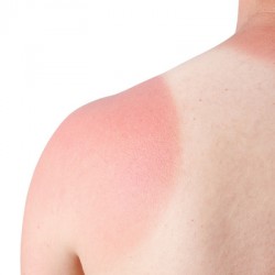 Sonnenbrand – Grad 1 bis Grad 3 Sonnenbrand (© juefraphoto - Fotolia.com)