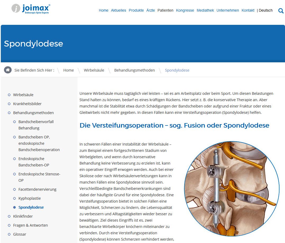 Spondylodese Operation zur Versteifung der Wirbelsäule (Versteifungsoperation, Fusion von Wirbeln an HWS und LWS), gut erklärt unter joimax.com/de/wirbelsaule/behandlungsmethoden/versteifungs-op/ (Screenshot vom 15.06.2017)