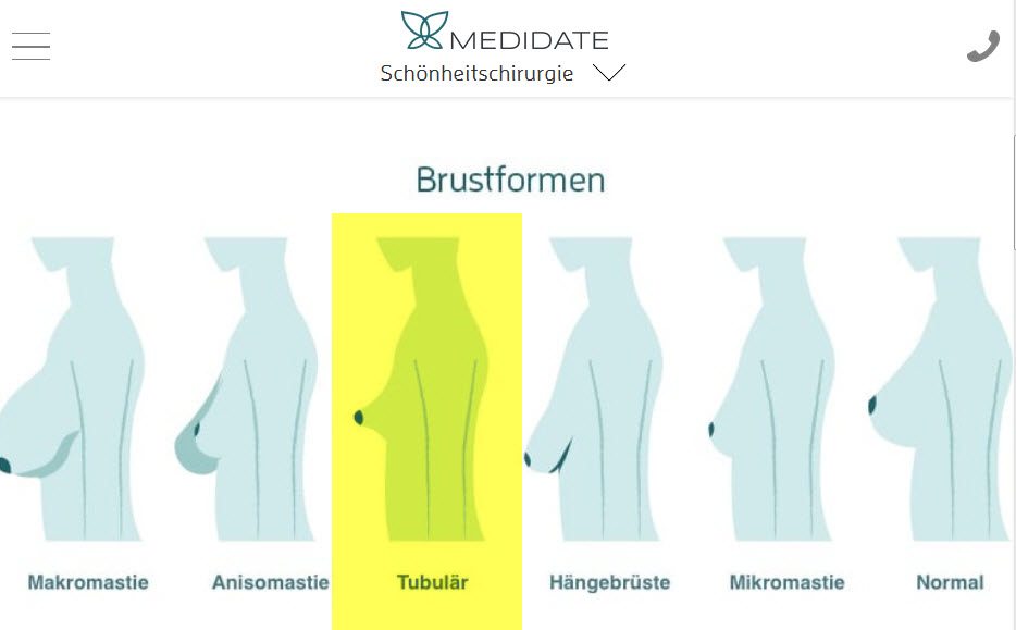 Tubuläre Brüste (Rüsselbrüste, Schlauchbrüste) und andere Brustdeformationen / -fehlbildungen im Überblick bei medidate.de (Screenshot https://medidate.de/brust-op/brustfehlbildungen/ am 17.08.2017) Tubuläre Brüste (Rüsselbrüste, Schlauchbrüste) und andere Brustdeformationen / -fehlbildungen im Überblick bei medidate.de (Screenshot https://medidate.de/brust-op/brustfehlbildungen/ am 17.08.2017)