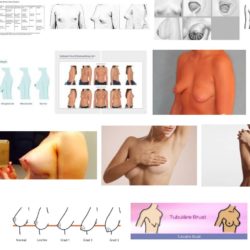 Tubuläre Brust / Rüsselbrust / Schlauchbrust – Was ist das? OP zur Korrektur? Tubuläre Brust / Schlauchbrust / Rüsselbrust (Screenshot Google-Bildersuche am 17.08.2017)