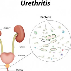 Harnröhrenentzündung: Symptome, Folgen, Behandlung Harnröhrenentzündung / Urethritis (© joshya - Fotolia.com)
