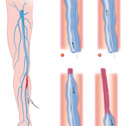 Varizen Stripping & Co: Verschiedene Verfahren zur Behandlung von Krampfadern Varizen Behandlung (© alexonline - Fotolia.com)