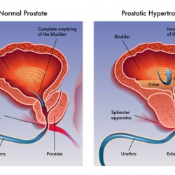 Vergrößerte Prostata: Symptome, unterschiedliche Therapiestufen Vergrößerte Prostata (© rob3000 - Fotolia.com)