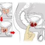 Vergrößerte Prostata verengt Harnröhre und macht Prostata OP nötig, z.B. mit dem Da Vinci Roboter (© kocakayaali / Fotolia)