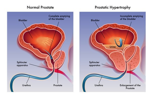 Vergrößerte Prostata (© rob3000 - Fotolia.com)