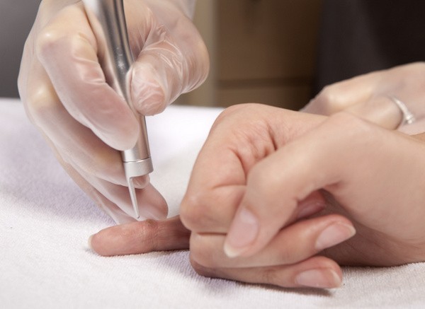 Warzen entfernen durch Vereisung oder mit Laser? (© bartekwardziak - Fotolia.com)