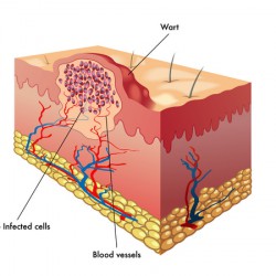 Warzen im Genitalbereich Warzen im Genitalbereich: Hautwucherung durch Infektion mit HPV-Virus (© rob3000 - Fotolia.com)