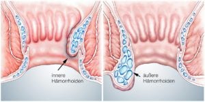 Nicht "Hemoriden", nicht "Hemorieden" und auch nicht "Hämorriden" werden sie geschrieben, sondern "Hämorrhoiden" - hier innerlich und äußerlich. Letzteres ist das (spürbarere) Problem und Bedarf früher oder später einer Behandlung. Doch was tun, wenn normale Mittel gegen die Symptome nicht mehr helfen? (© Henrie / stock.adobe.com)