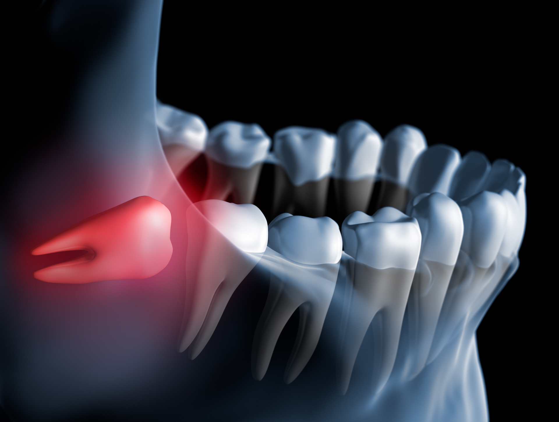 Weisheitszahnentfernung - Was muss man wissen? (© psdesign1 / Fotolia)