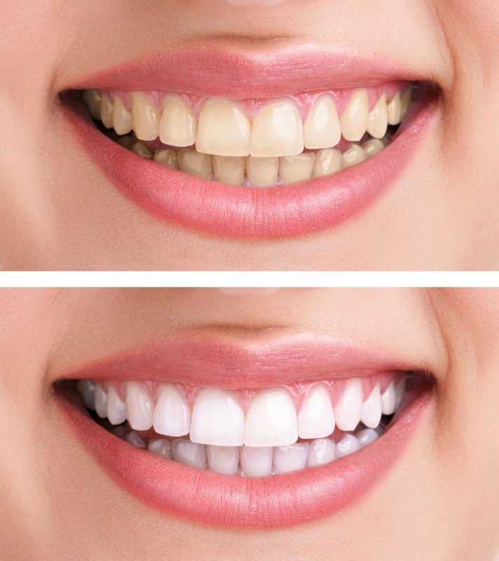 Zähne bleichen | Bilder: vorher / nachher - Die Aufhellung ist deutlich sichtbar, auf dem unteren Bild ist das Lächeln deutlich strahlender (© Igor Mojzes / Fotolia)