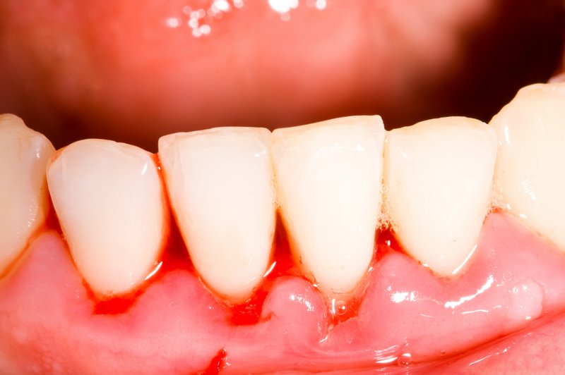 Zahnfleischbluten | Geht der Zahnfleischrückgang mit einer Entzündung des Zahnfleischs einher, blutet der Zahnfleischrand häufig auch beim Putzen der Zähne (© Zsolt Bota Finna / Fotolia)