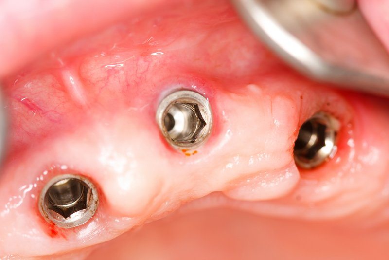Aufnahmegewinde für Zahnimplantat; darauf kann dann eine Zahnprothese gesetzt werden - "Implantat-getragene Zahnprothesen" (© Sandor Kacso / Fotolia)