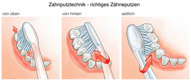 Richtiges Zähneputzen gegen Zahnfleischschwund - Eine falsche Zahnputztechnik kann auf Dauer zu einer Rezession des Zahnfleischs führen, auch ganz ohne Zahnfleischentzündung (© Henrie / Fotolia)