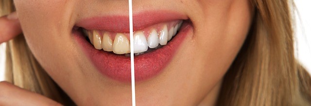 Die Zahnreinigung bringt neben medizinischen auf kosmetische Effekte – auch wenn eine so starke Veränderung wohl nur durch andere zahnärztliche Maßnahmen möglich ist. (© geralt / pixabay.com)