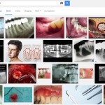 Zahnzyste in Bildern: Screenshot einer Google Bildersuche nach 'Zahnzysten'