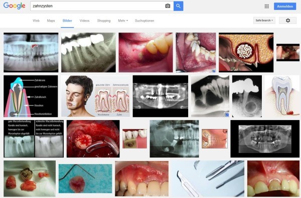 Zyste am Zahn | Zahnzyste in Bildern: Screenshot einer Google Bildersuche nach 'Zahnzysten'