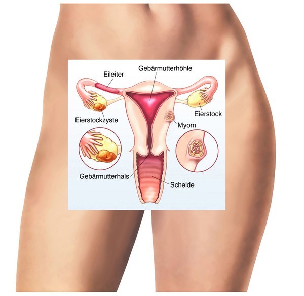 Vagina, Gebärmutter, Eierstockzyste und Myom (© Henrie / Fotolia)