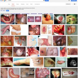 Zysten: Flüssigkeitsblasen an Eierstock, Gebärmutter, Brust Zysten Bilder: Google Bildersuche, Screenshot am 05.08.2014